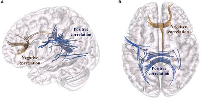 Structural Brain Network Reorganization Following Anterior Callosotomy for Colloid Cysts: Connectometry and Graph Analysis Results